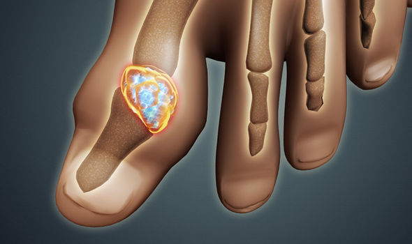 tratamentul padagra articular deteriorarea meniscului posterior al genunchiului